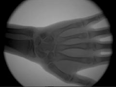 供应运动员骨龄检测医用便携式X光机